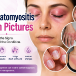 dermatomyositis rash pictures