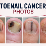 toenail cancer photos