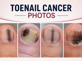 toenail cancer photos