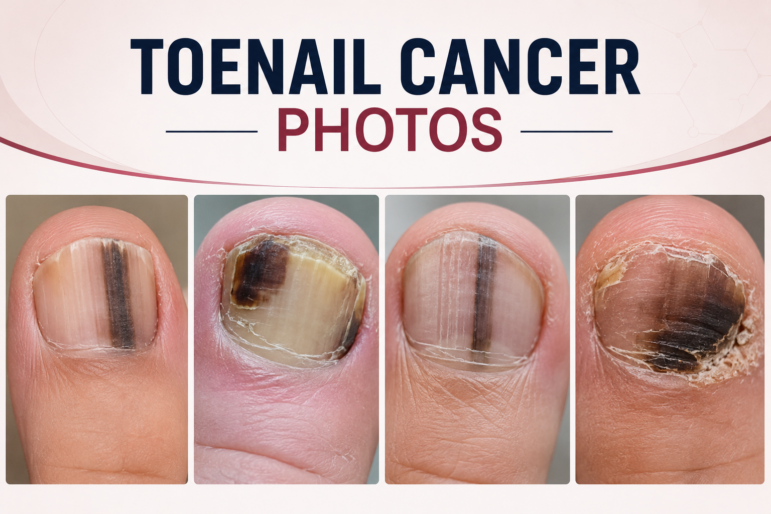toenail cancer photos