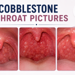 cobblestone throat pictures