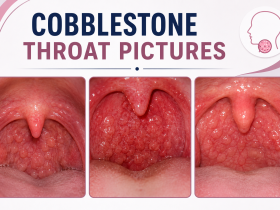 cobblestone throat pictures