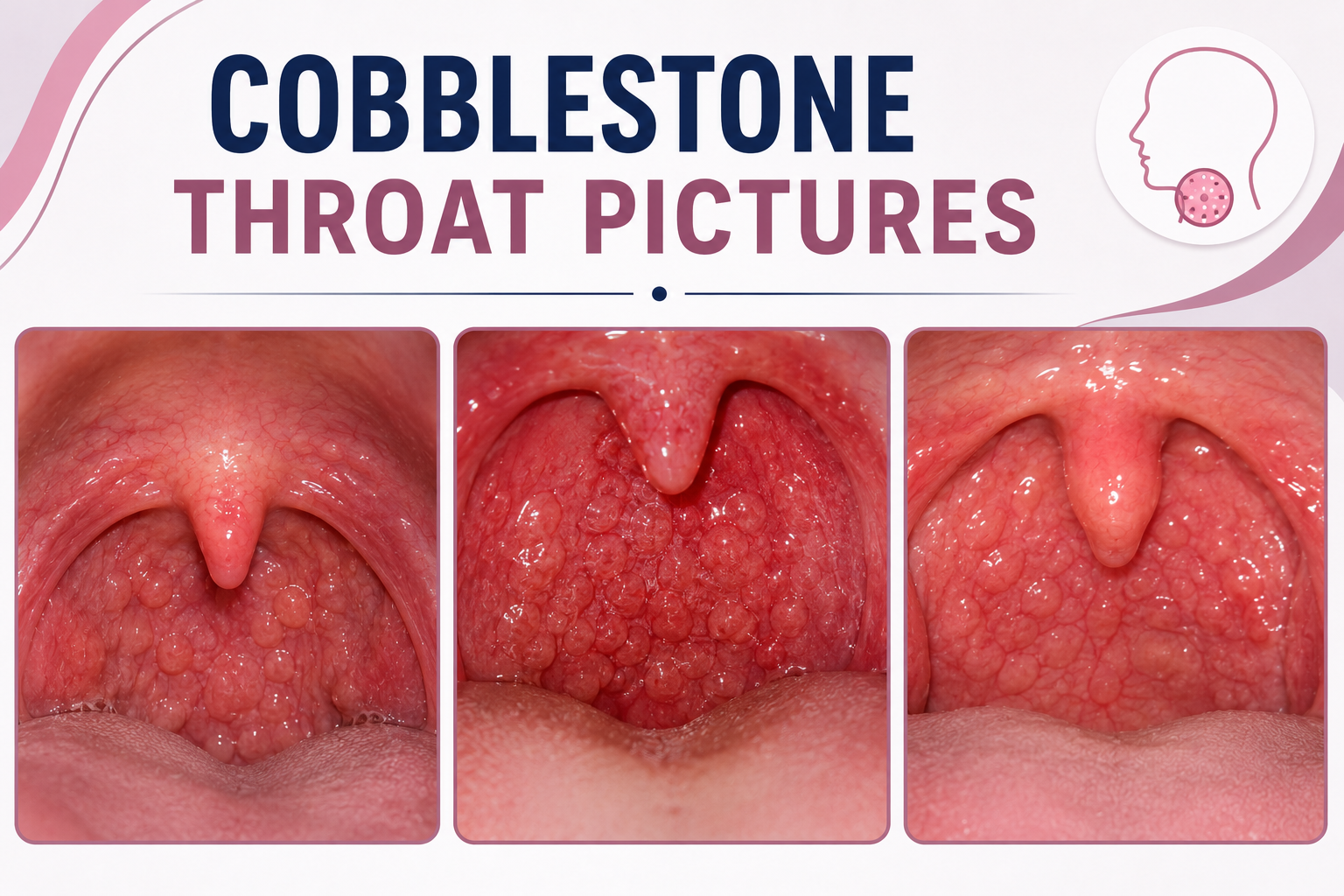 cobblestone throat pictures